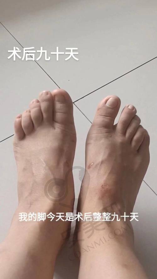 上海虹桥医院矫正大脚骨的技术水平如何？