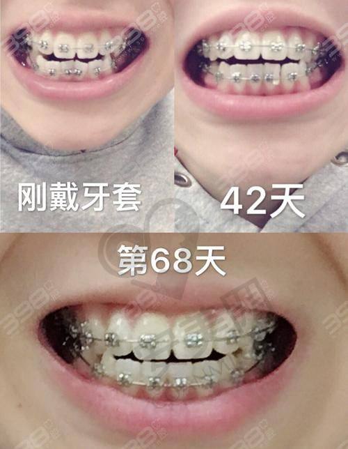 医生是如何为我进行隐形牙齿矫正方案设计的？