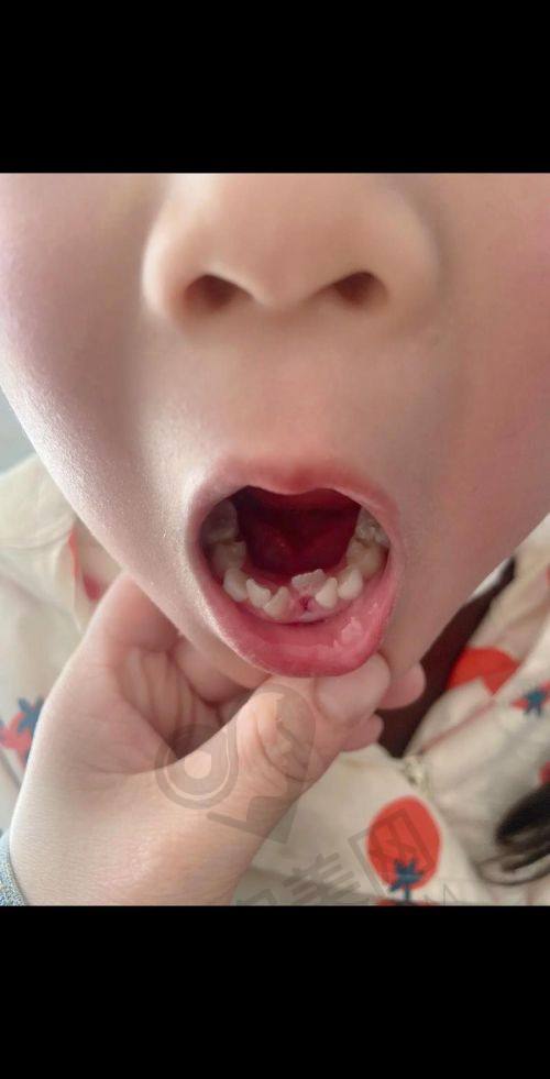 拔牙后的修复情况如何？