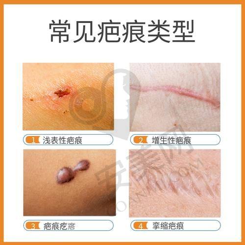 上海虹桥医院不同疤痕修复方法的价格差异是怎样的？