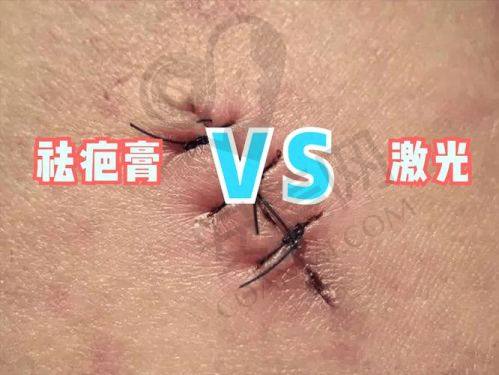 上海虹桥医院治疗疤痕疙瘩靠谱吗？