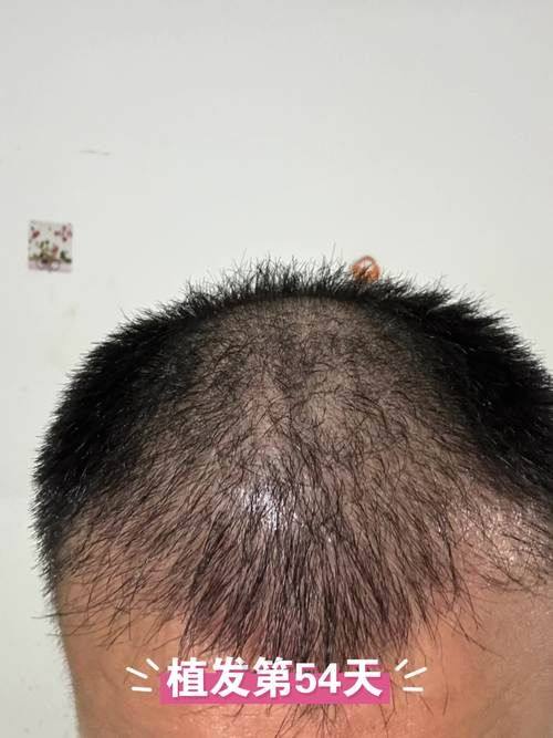 如何判断北京碧莲盛植发是否适合自己？