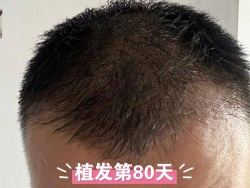 北京碧莲盛植发的品牌实力如何？