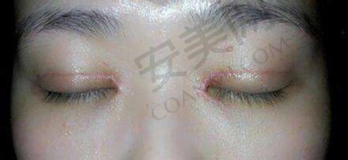 双眼皮修复就诊过程是怎样的？