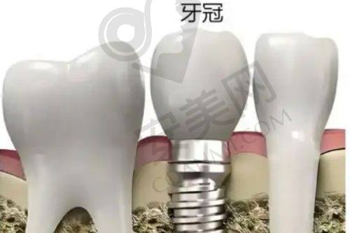 成都种植牙医院前十口碑推荐