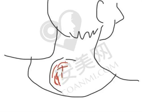 黄学峰一针去除富贵包价格为何是1.9w元起？