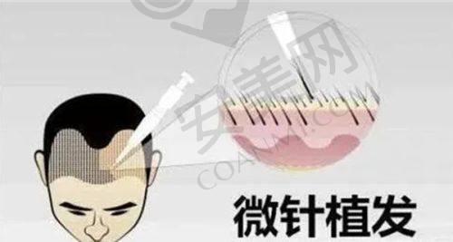 2、南京领秀植发李俊强医生擅长项目：