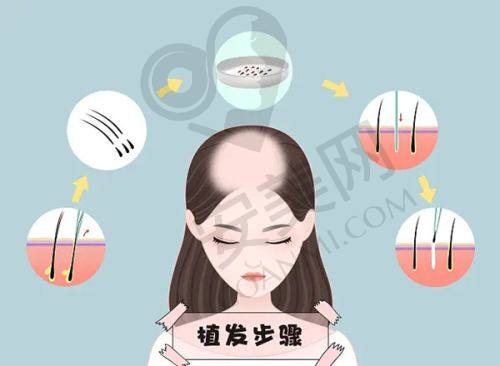 如何选择适合自己的植发方案？
