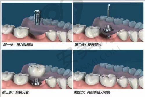达州绮云口腔杨晓日医生怎么样？