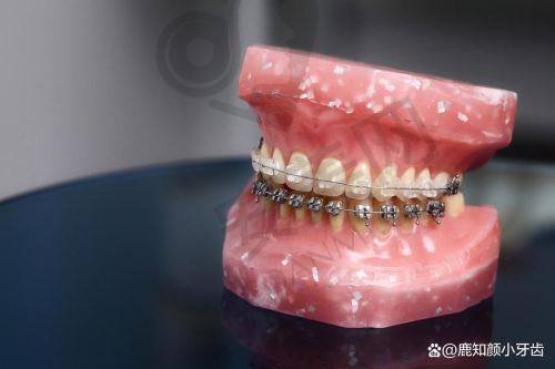 深圳慈恩口腔医院隐适美隐形矫正的成效如何？