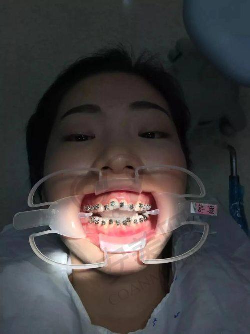 为什么选择深圳慈恩口腔医院进行隐适美隐形矫正？