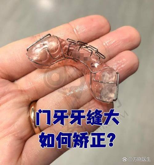 深圳慈恩口腔医院的隐适美隐形矫正是什么？