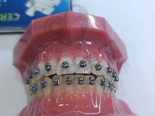 达州绮云口腔医院金属托槽牙齿矫正的优势有哪些？
