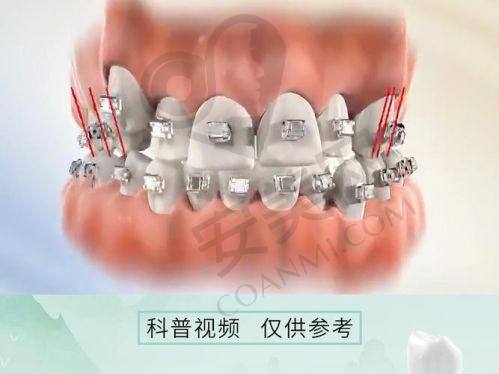 达州绮云口腔医院金属托槽牙齿矫正的过程是怎样的？