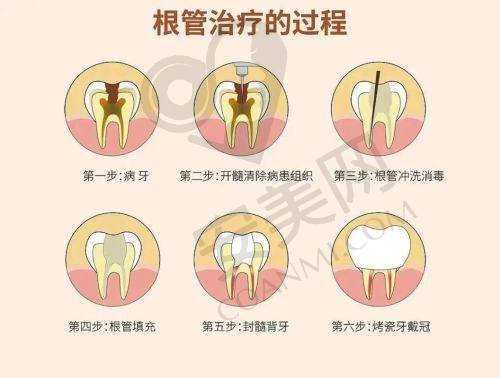 宁波余姚冠杨口腔根管治疗与其他医院相比有何不同？