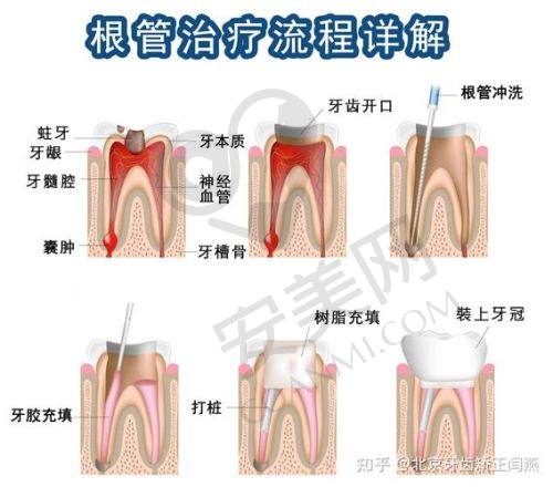 宁波余姚冠杨口腔根管治疗价格分阶情况如何？