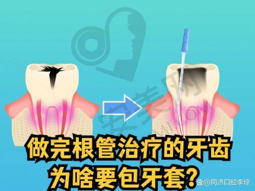 宁波余姚冠杨口腔根管治疗价格为何如此吸引人？