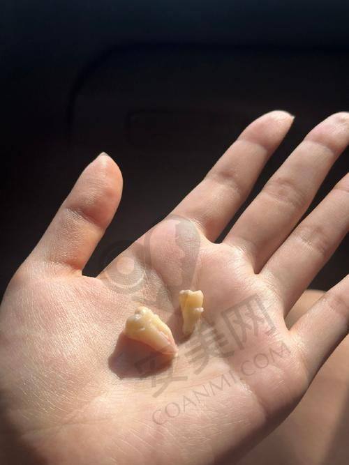 患者在汕尾陆丰莱恩口腔拔智齿的真实实例分享