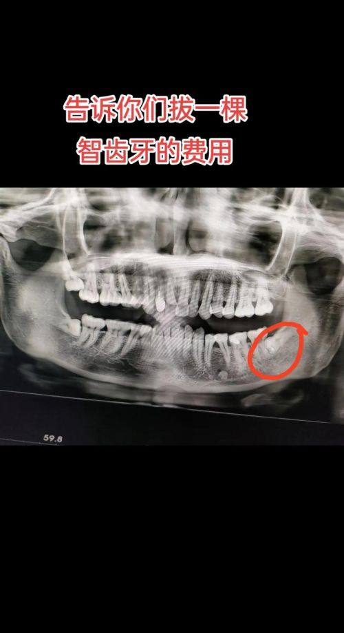 为什么拔智齿要选择汕尾陆丰莱恩口腔？