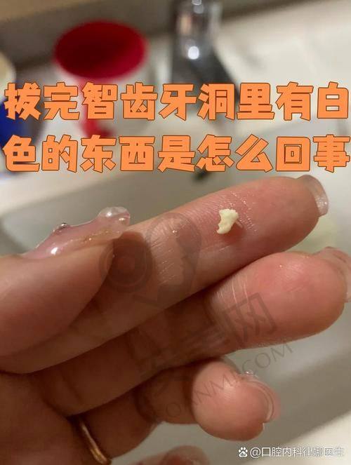 汕尾陆丰莱恩口腔拔智齿有哪些优势？