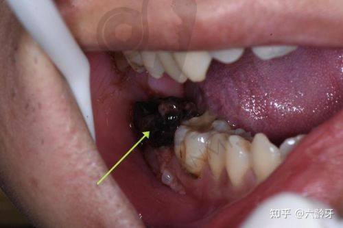如何在汕尾陆丰莱恩口腔预约拔智齿？