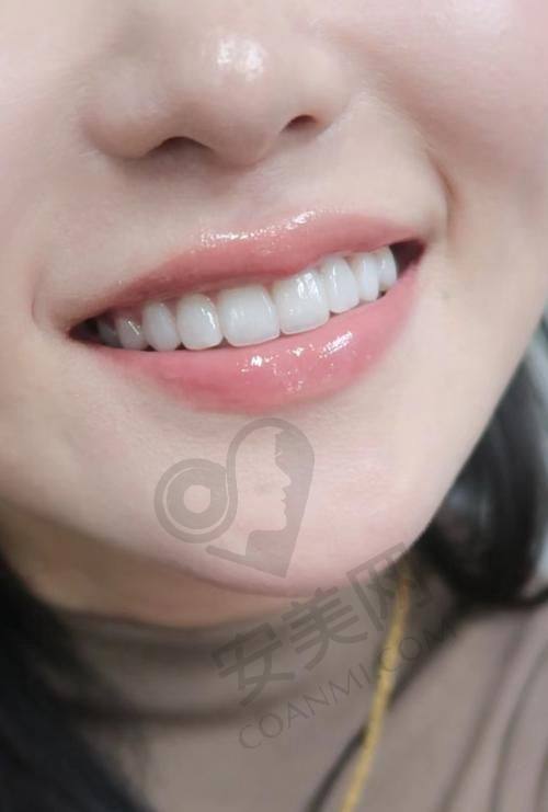 乌鲁木齐牙博士口腔的牙齿瓷贴面美白有哪些优势？