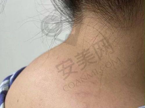 黄学峰一针去除富贵包有哪些优势？