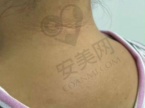 哪些人适合黄学峰一针去除富贵包技术？