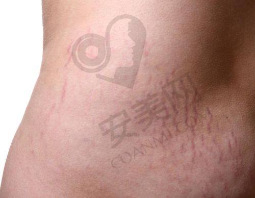 什么是妊娠纹，为何如此顽固？