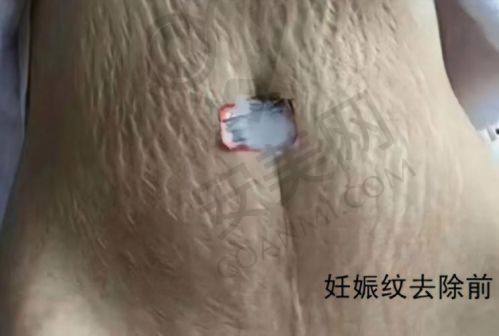 成都军建医院修复妊娠纹的价格是怎样的？