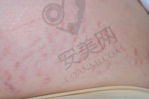 患者在成都军建医院修复妊娠纹的成效如何？