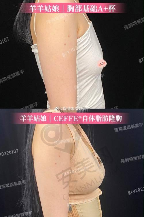 南京米兰柏羽自体脂肪丰胸的术后护理重要吗？