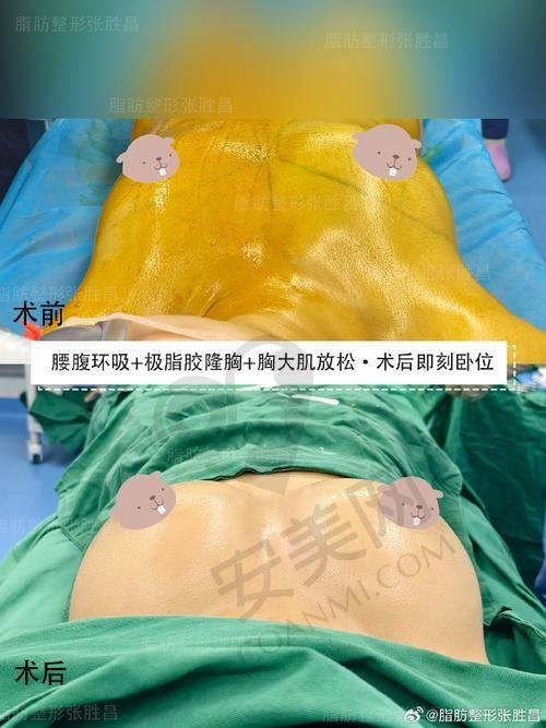 脂肪丰胸技术到底有啥特色？