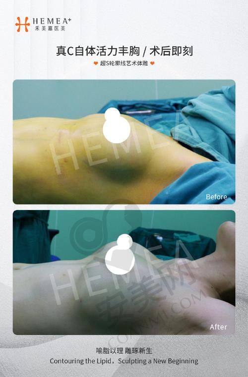 选择南京米兰柏羽自体脂肪丰胸有哪些保护？