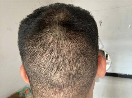 发际线种植技术有什么特色？