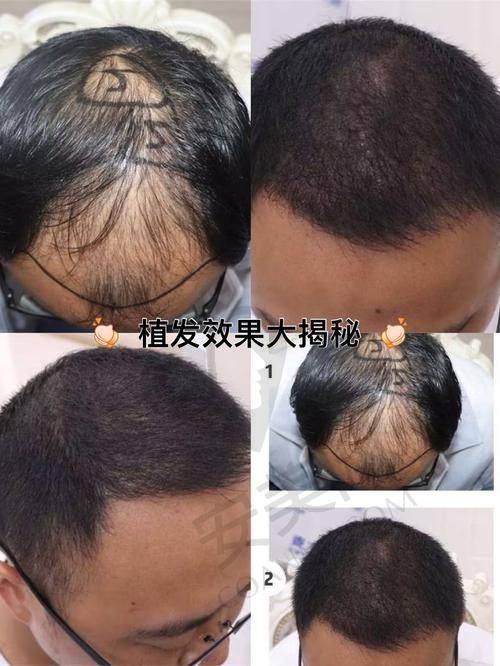 在成都大麦微针植发如何节省费用？