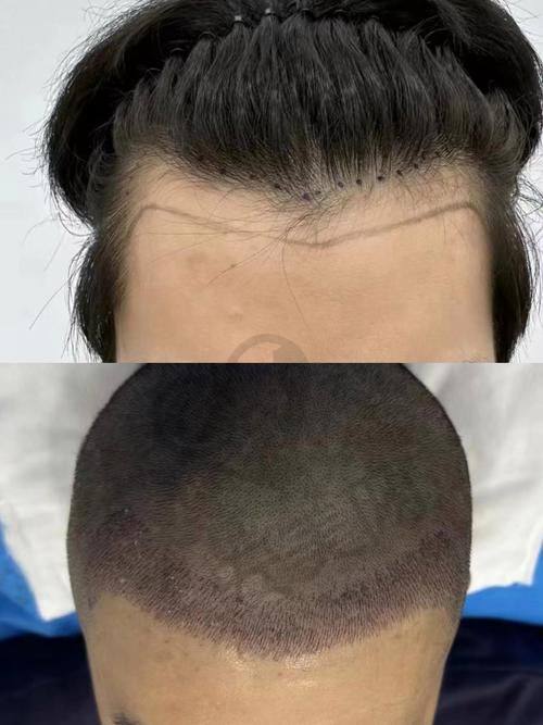 成都大麦植发医院怎么样？靠谱吗？