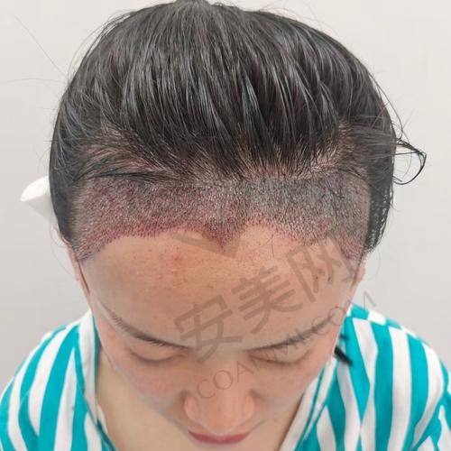 南京领秀植发医院的服务质量怎么样？用户评价反馈