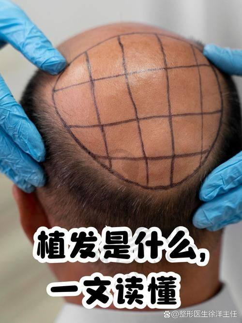 南京领秀FUE植发技术的术后成效如何？