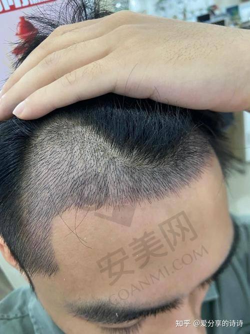 南京领秀在植发过程中如何保护患者的安心？