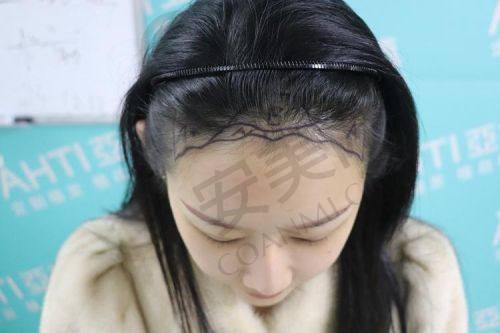 什么是FUE植发技术？