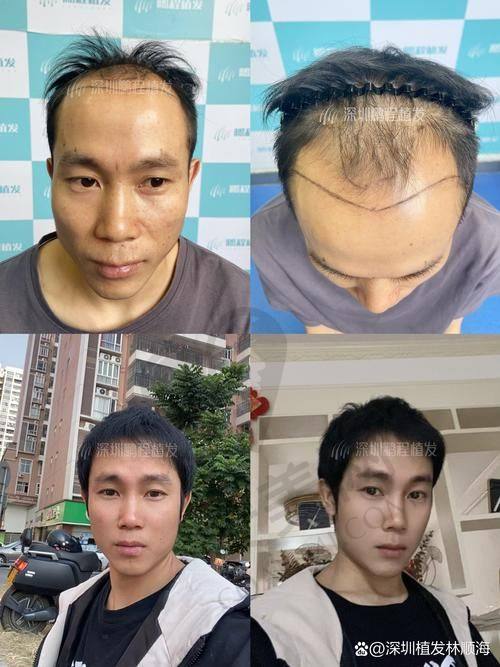 成都大麦植发发际线种植的成效如何？
