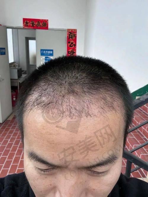 南京领秀FUE植发技术价格分阶情况