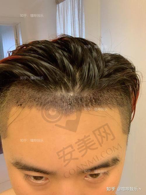 成都大麦微针植发不同项目的价格大概是多少？