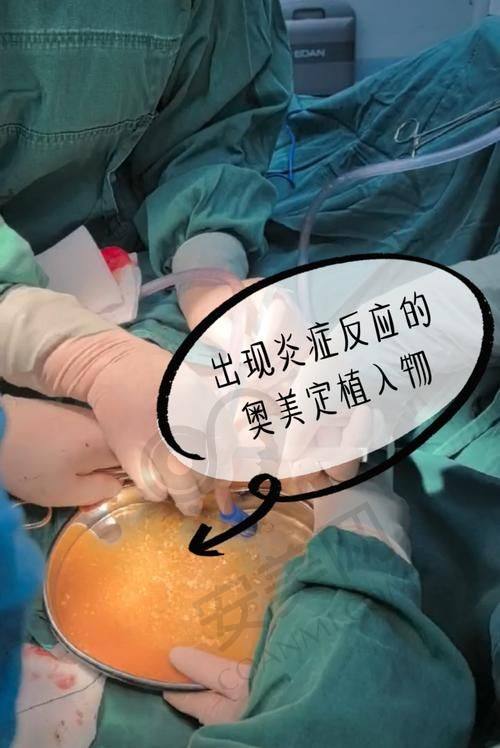 周云超医生为何能安心精细清除胸部隐患？