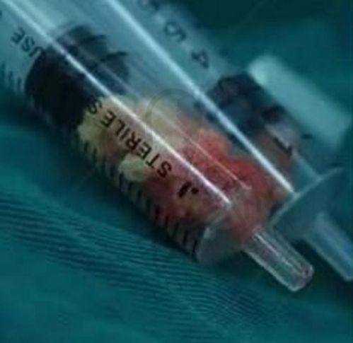 患者对周云超医生胸部异物取出的评价如何？