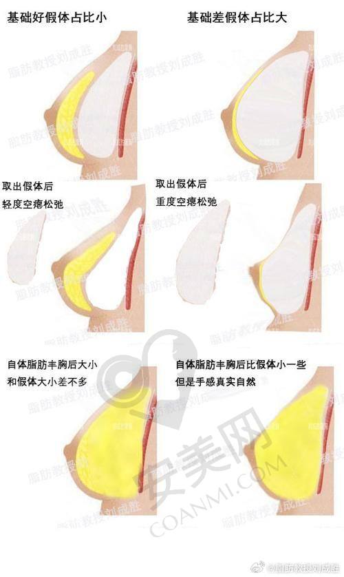 南京美莱整形的假体隆胸术后成效如何保护？