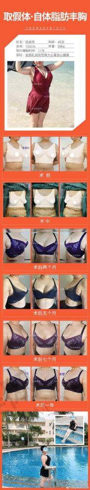 选择东莞爱思特假体隆胸安心吗？