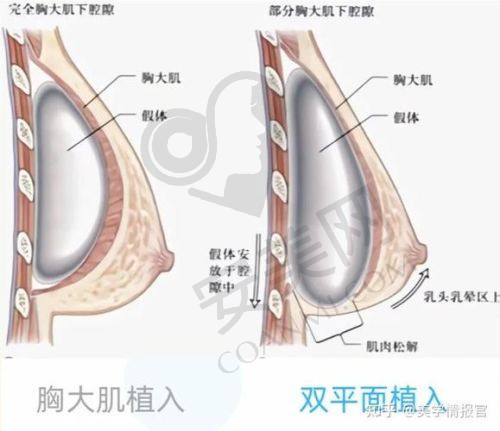 东莞爱思特假体隆胸成效能维持多久？