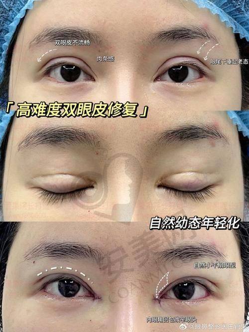 双眼皮修复医生怎么选？